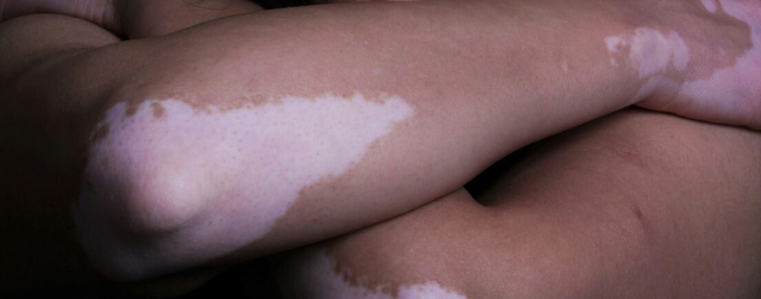 Vitiligo : signification émotionnelle et symbolique des taches blanches